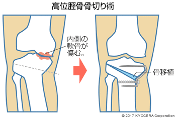 高位脛骨骨切り術