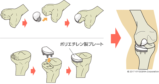 人工膝関節単顆置換術（UKA）の例