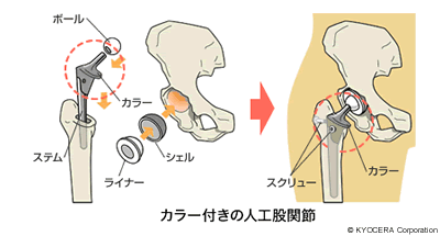 カラー付きの人工股関節