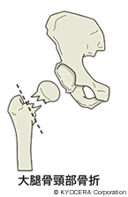 大腿骨頸部骨折