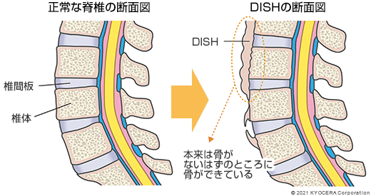 正常な脊椎の断面図 DISHの断面図