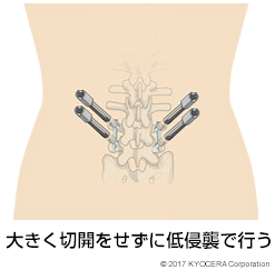 大きく切開をせずに低侵襲で行う