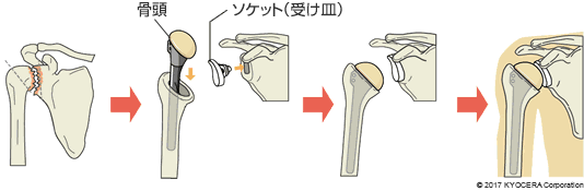 従来タイプの人工肩関節置換術の例