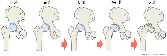 変形性股関節症 前期、初期、進行期、末期