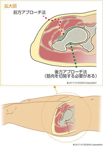 前方アプローチ法 後方アプローチ法