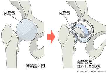 関節包 股関節外観 関節包をはがした状態