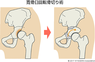 寛骨臼回転骨切り術