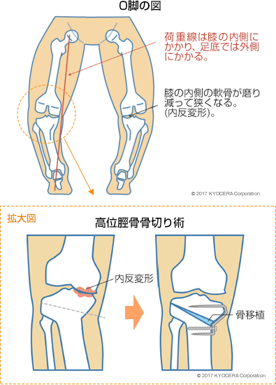 O脚の図 高位脛骨骨切り術