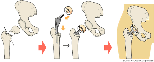 人工骨頭置換術の例