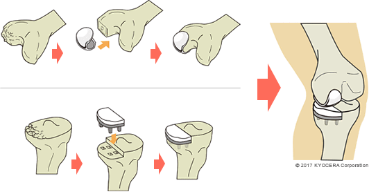 単顆人工膝関節置換術の例
