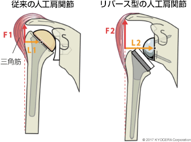 従来の人工肩関節 リバース型の人工肩関節