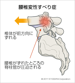 腰椎変性すべり症