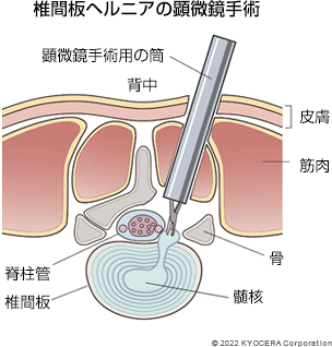 椎間板ヘルニアの顕微鏡手術