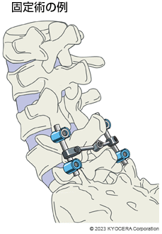 固定術の例