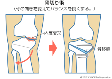 骨切り術