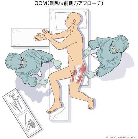 OCM（側臥位前側方アプローチ）