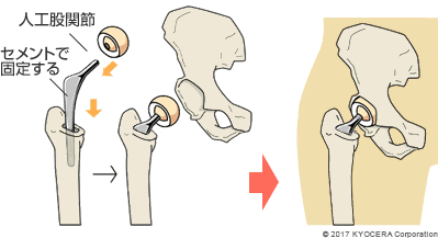 セメントタイプの人工骨頭置換術の例