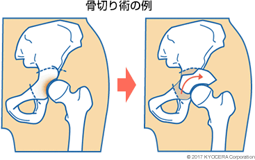 骨切り術の例