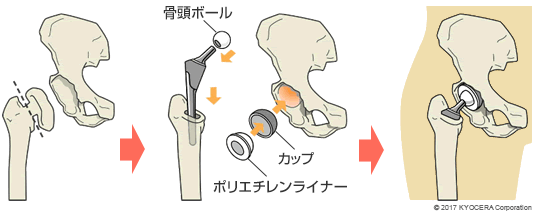 人工股関節置換術の例