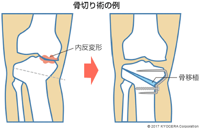 骨切り術の例