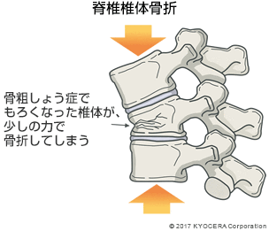 脊椎椎体骨折
