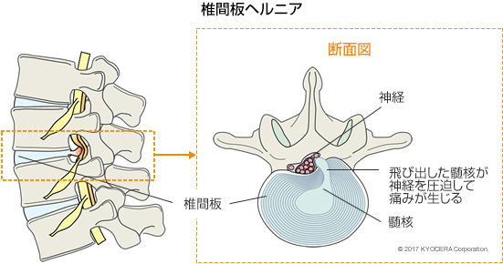 椎間板ヘルニア