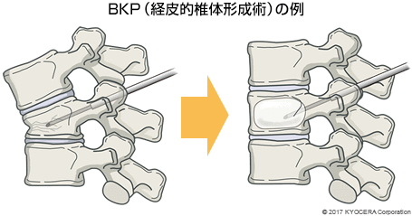 BKP（経皮的椎体形成術）の例
