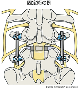 固定術の例