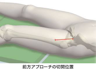 前方アプローチの切開位置