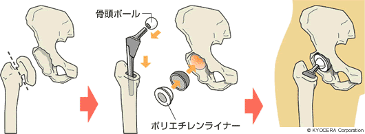 全人工股関節置換術（Total Hip Arthroplasty：THA）