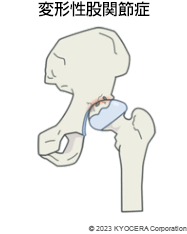 変形性股関節症
