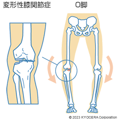 変形性膝関節症 O脚