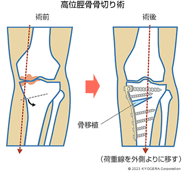 高位脛骨骨切り術