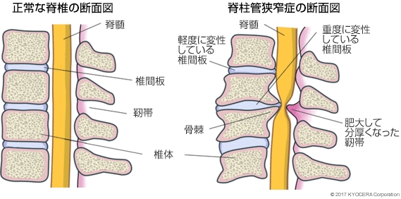 正常な脊椎の断面図 脊柱管狭窄症の断面図