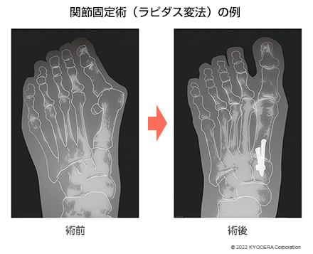 関節固定術（ラピダス変法）の例