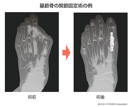 基節骨の関節固定術の例