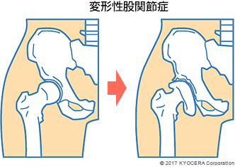 変形性股関節症