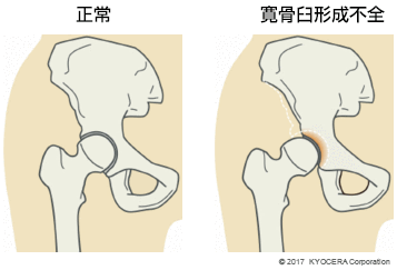 寛骨臼形成不全