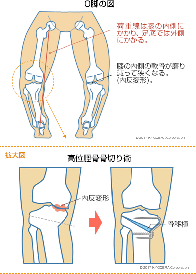 O脚の図、高位脛骨骨切り術