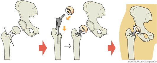 人工骨頭置換術の例