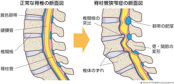 正常な脊椎の断面図 脊柱管狭窄症の断面図