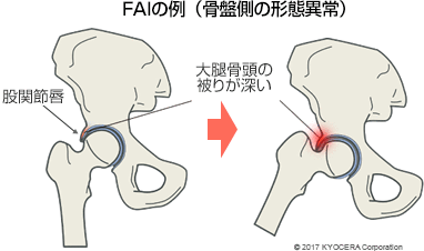 ピンサータイプ FAIの例（骨盤側の形態異常）