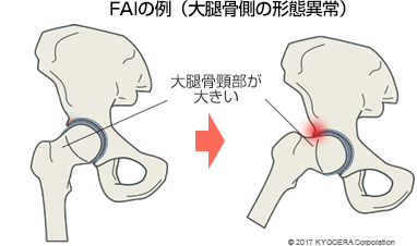 キャムタイプ FAIの例（大腿骨側の形態異常）