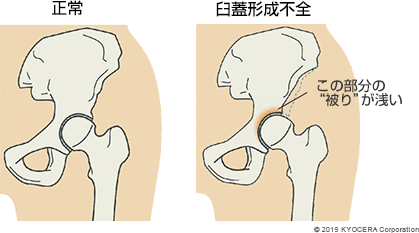 正常 臼蓋形成不全