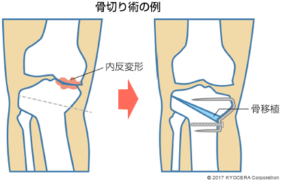 骨切り術の例