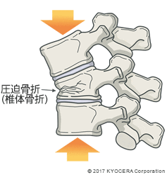 圧迫骨折(椎体骨折)