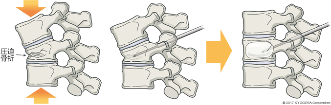 BKP（経皮的椎体形成術）