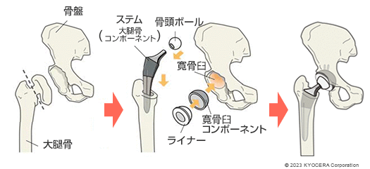 人工股関節置換術の例