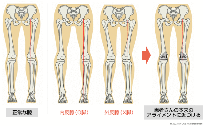 キネマティックアライメント法