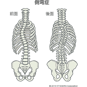 側弯症